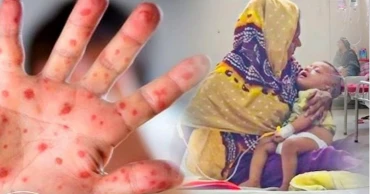 ঝিনাইদহে হাম ও উপসর্গ নিয়ে দেড় মাসে হাসপাতালে ভর্তি ১০৫, মৃত্যু নেই