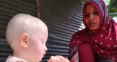 Man divorces wife over albino baby in Jashore; mother, child struggle to survive