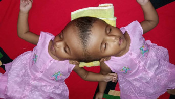 Bangladeshi conjoined twins flying to Hungary